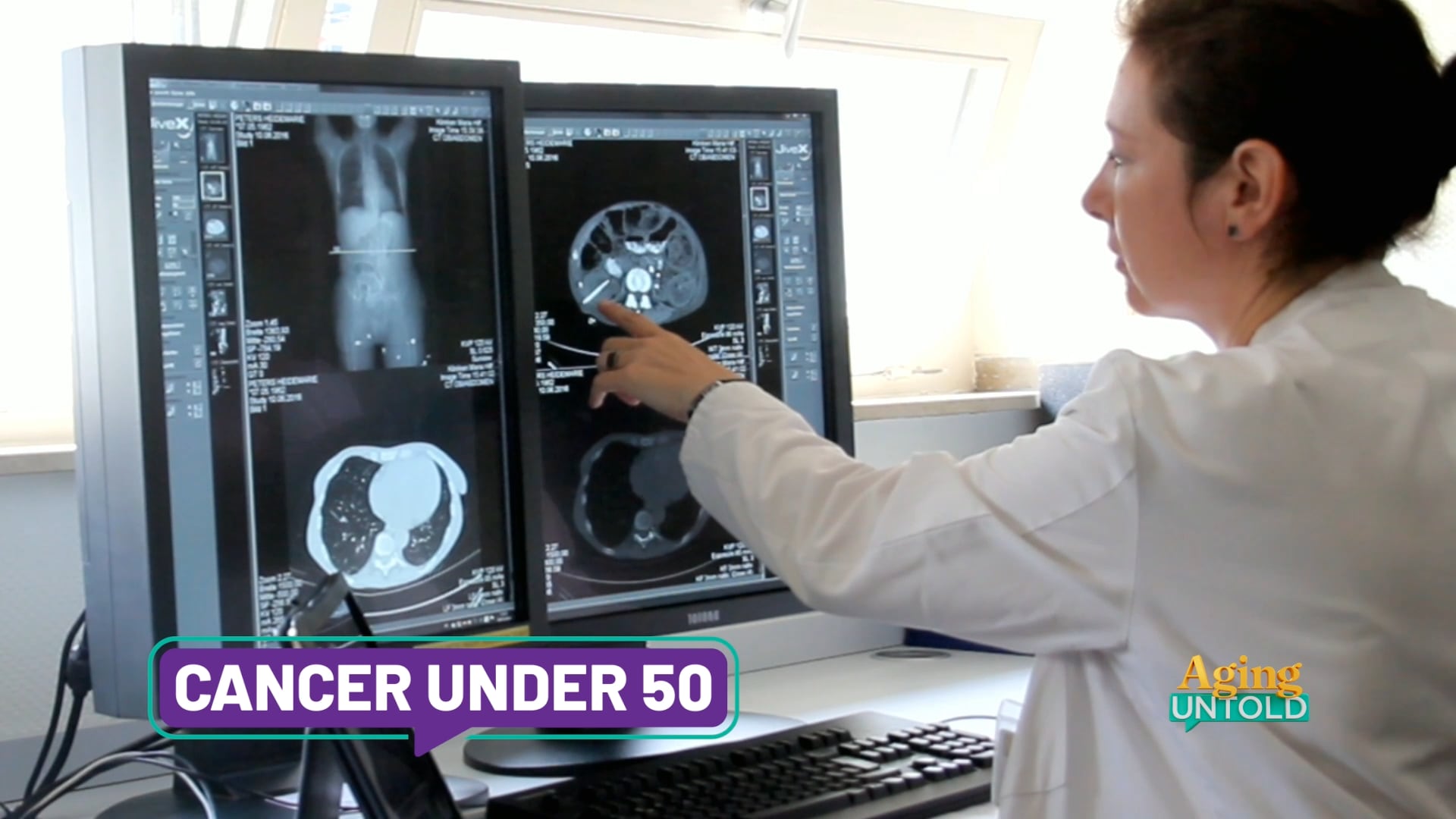 Cancer Rates Rise Among Younger Adults, Highlighting Need for Early Detection